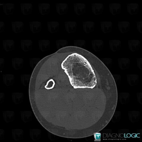 Enchondroma, Tibia - Mid part, CT