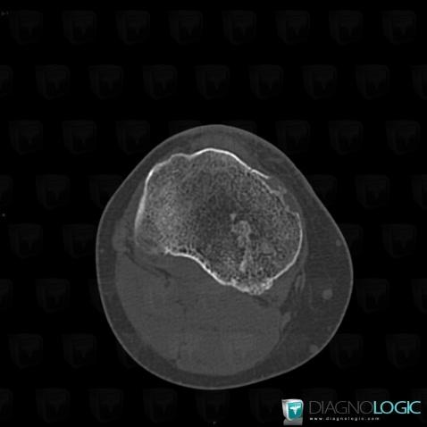 Enchondroma, Tibia - Proximal part, CT