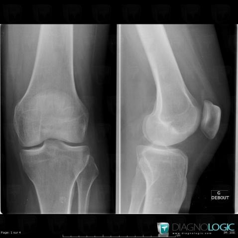 Enchondroma, Tibia - Proximal part, X rays