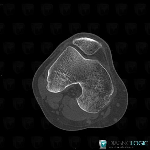 Enchondromatosis, Femur - Distal part, CT