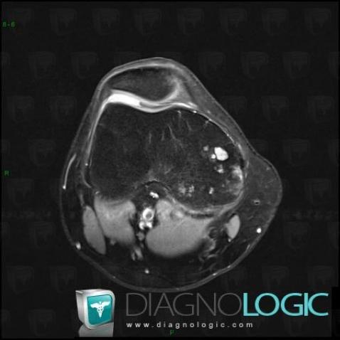 Enchondromatosis, Femur - Distal part, MRI