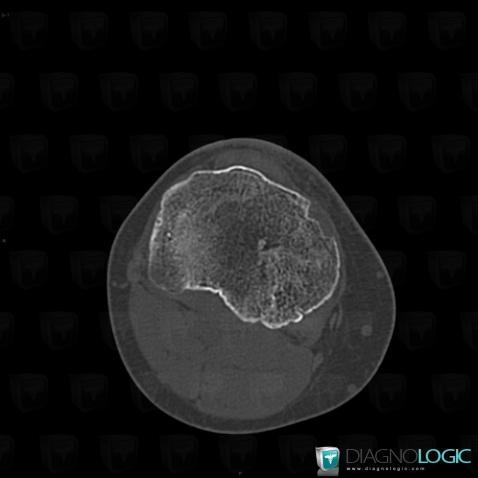 Enchondromatosis, Tibia - Proximal part, CT