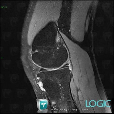 Enchondromatosis, Tibia - Proximal part, MRI