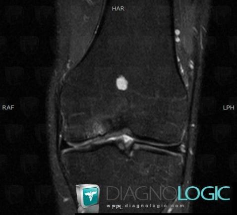 Enchondrome, Fémur -inférieur, IRM