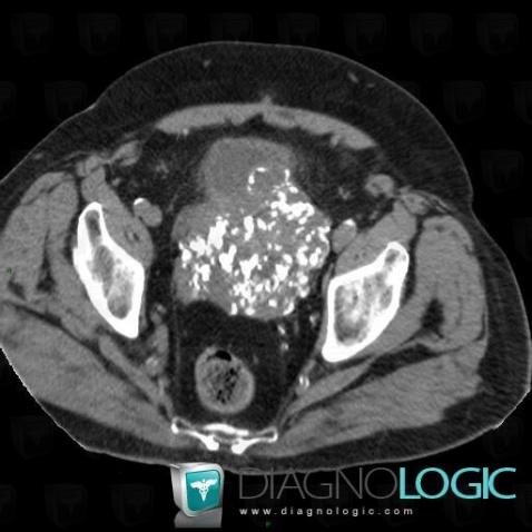 Encrusted cystitis, Urinary bladder, CT