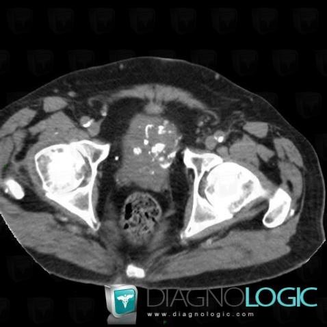 Encrusted cystitis, Urinary bladder, CT