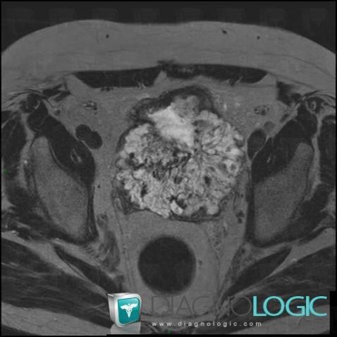 Encrusted cystitis, Urinary bladder, MRI