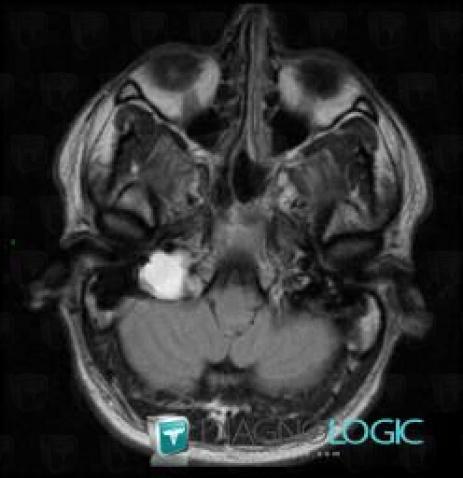 Endolymphatic sac tumor, Temporal bone, MRI