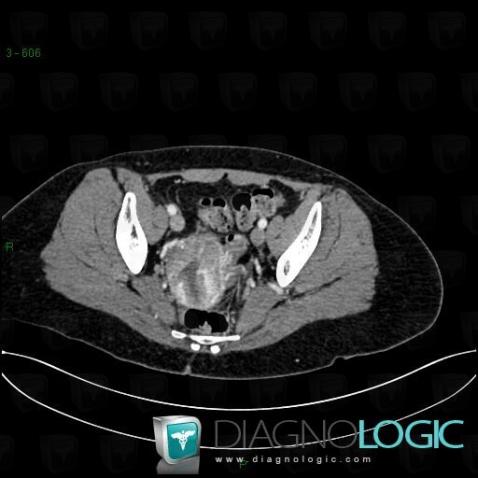 Endometrial adenocarcinoma, Uterus, CT