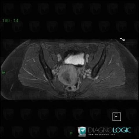 Endometrial adenocarcinoma, Uterus, MRI