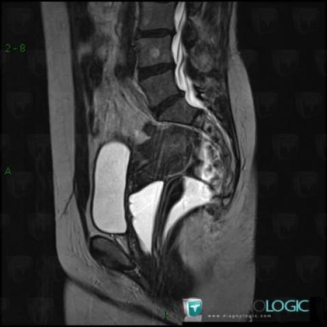 Endometrial adenocarcinoma, Uterus, MRI