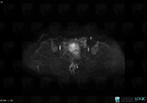 Endometrial adenocarcinoma, Uterus, MRI