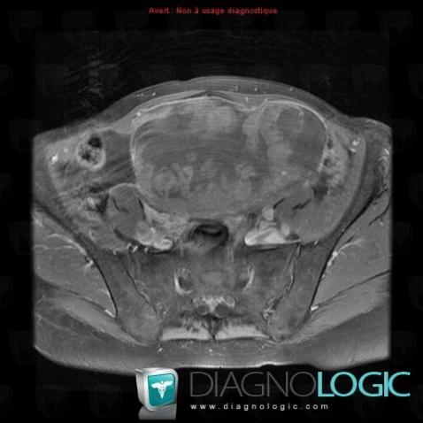 Endometrioid carcinoma, Adnexa / Ovary fallopian tube, MRI