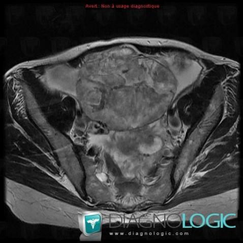 Endometrioid carcinoma, Adnexa / Ovary fallopian tube, MRI