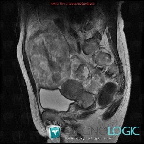 Endometrioid carcinoma, Pelvis / Perineum, MRI