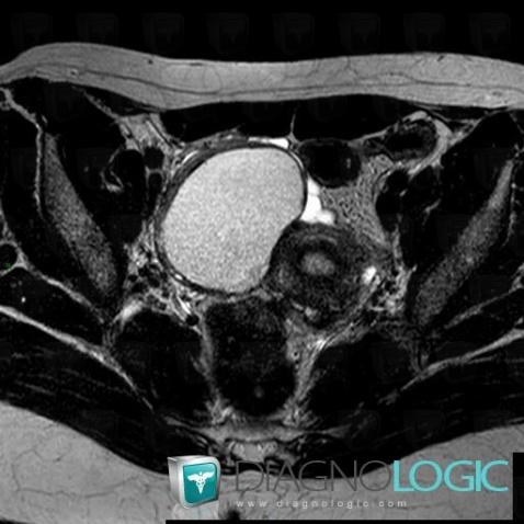 Endometrioma, Adnexa / Ovary fallopian tube, MRI