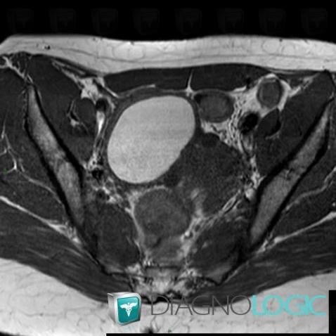 Endometrioma, Adnexa / Ovary fallopian tube, MRI