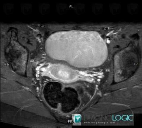 Endometrioma, Adnexa / Ovary fallopian tube, MRI