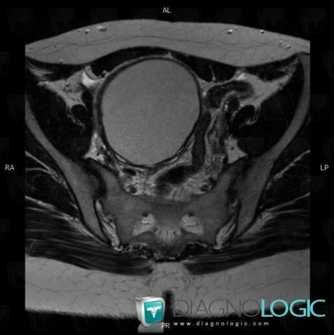 Endometrioma, Adnexa / Ovary fallopian tube, MRI