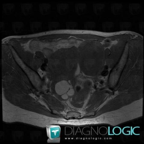 Endometrioma, Adnexa / Ovary fallopian tube, MRI