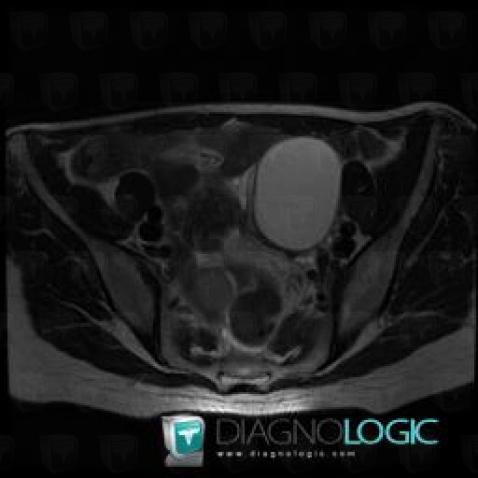 Endometrioma, Adnexa / Ovary fallopian tube, MRI