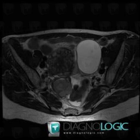 Endometrioma, Adnexa / Ovary fallopian tube, MRI