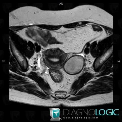 Endometrioma, Adnexa / Ovary fallopian tube, MRI