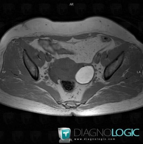 Endometrioma, Adnexa / Ovary fallopian tube, MRI