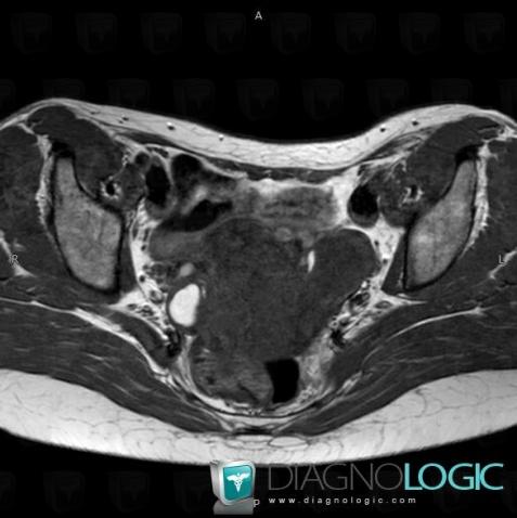 Endometrioma, Adnexa / Ovary fallopian tube, MRI