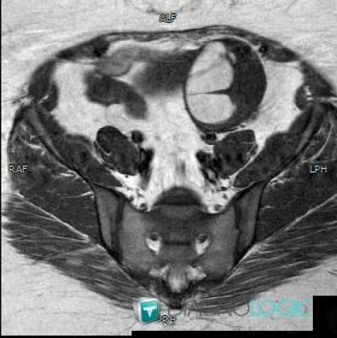 Endometrioma, Adnexa / Ovary fallopian tube, MRI