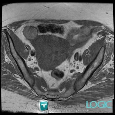 Endometrioma, Adnexa / Ovary fallopian tube, MRI