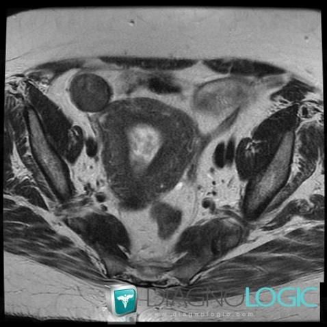 Endometrioma, Adnexa / Ovary fallopian tube, MRI