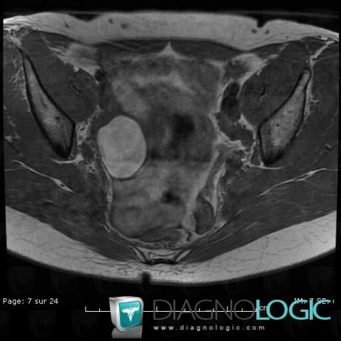 Endometrioma, Adnexa / Ovary fallopian tube, MRI