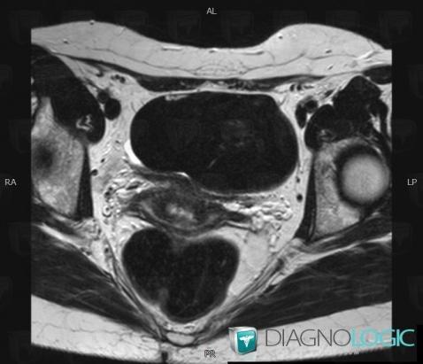 Endometrioma, Adnexa / Ovary fallopian tube, Pelvis / Perineum, MRI
