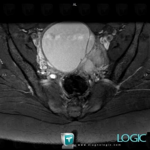 Endometrioma, Adnexa / Ovary fallopian tube, Pelvis / Perineum, MRI