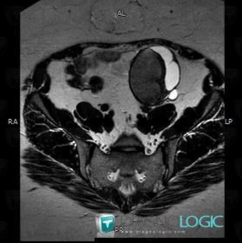 Endometrioma, Adnexa / Ovary fallopian tube, Pelvis / Perineum, MRI