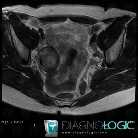 Endometrioma, Adnexa / Ovary fallopian tube, Pelvis / Perineum, MRI