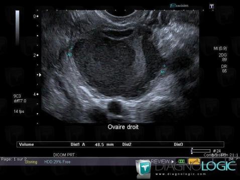 Endometrioma, Adnexa / Ovary fallopian tube, Pelvis / Perineum, US