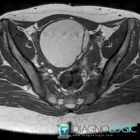 Endometrioma, Pelvis / Perineum, MRI