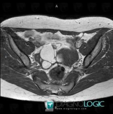 Endométriome, Annexe / Ovaire - trompe, IRM