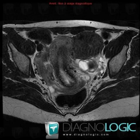 Endometriosis, Adnexa / Ovary fallopian tube, MRI