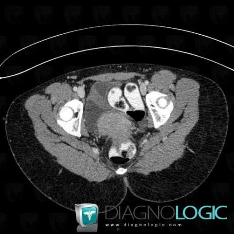 Endometriosis, Mesentery / Peritoneum, CT