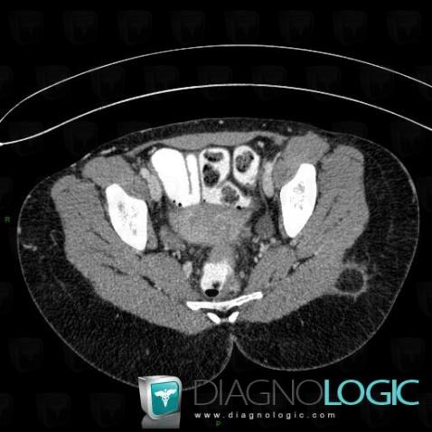 Endometriosis, Pelvis / Perineum, CT