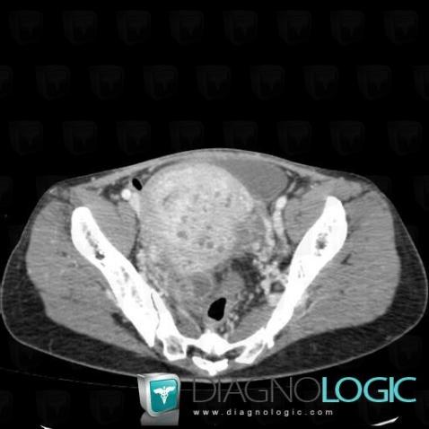 Endometritis, Uterus, CT