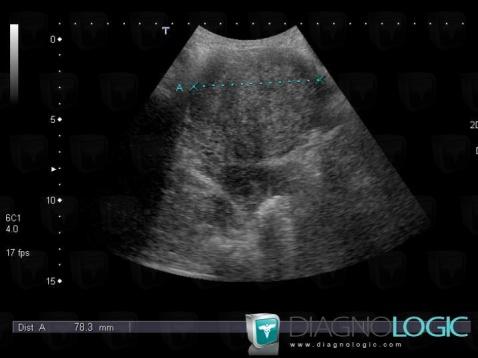 Endometritis, Uterus, US