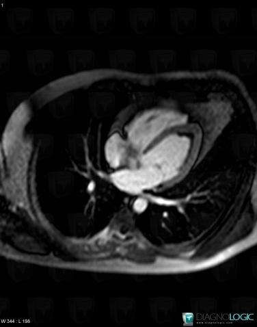 Endomyocardial fibrosis, Cardiac cavities / Pericardium, MRI