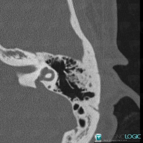 Enlarged vestibular aqueduct, Inner ear, CT