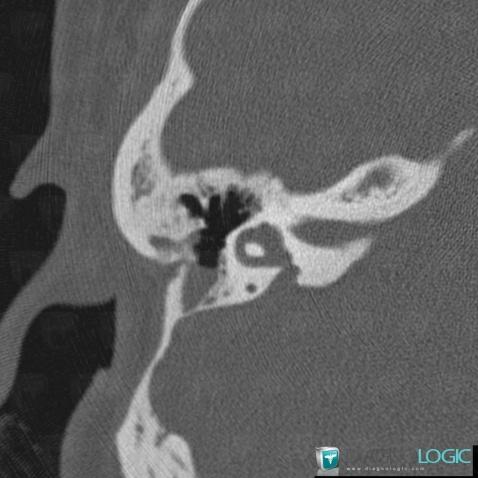 Enlarged vestibular aqueduct, Temporal bone, CT