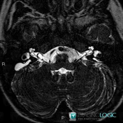 Enlarged vestibular aqueduct, Temporal bone, Inner ear, MRI