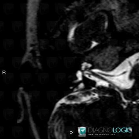 Enlarged vestibular aqueduct, Temporal bone, Inner ear, MRI